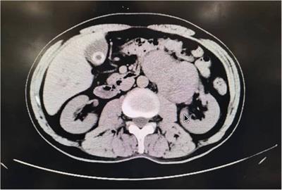 Retroperitoneal undifferentiated pleomorphic sarcoma with total nephrectomy: a case report and literature review